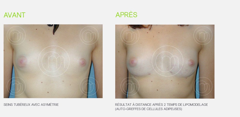 Photo avant / après lipofilling pour augmentation mammaire
