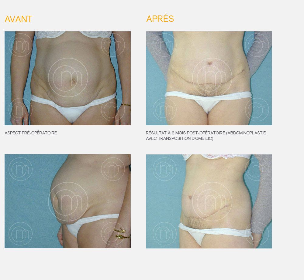 Photo avant / après plastie abdominale