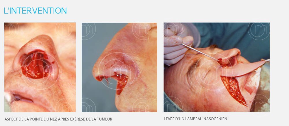 Photo chirurgie dermatologique carcinome