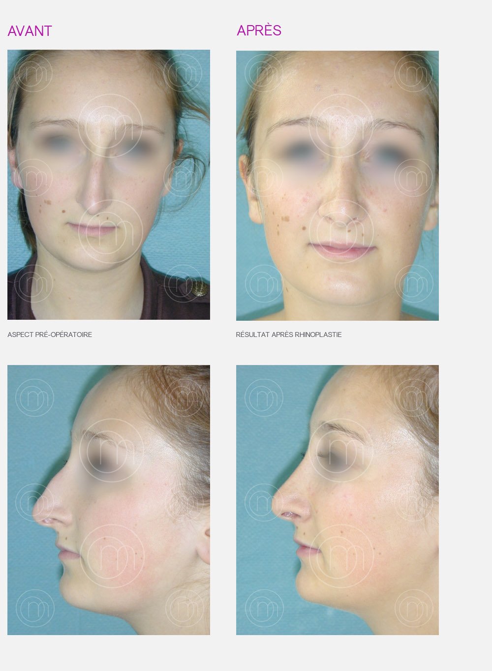 Photo avant / après de rhinoplastie par le Dr Manise chirurgien esthétique