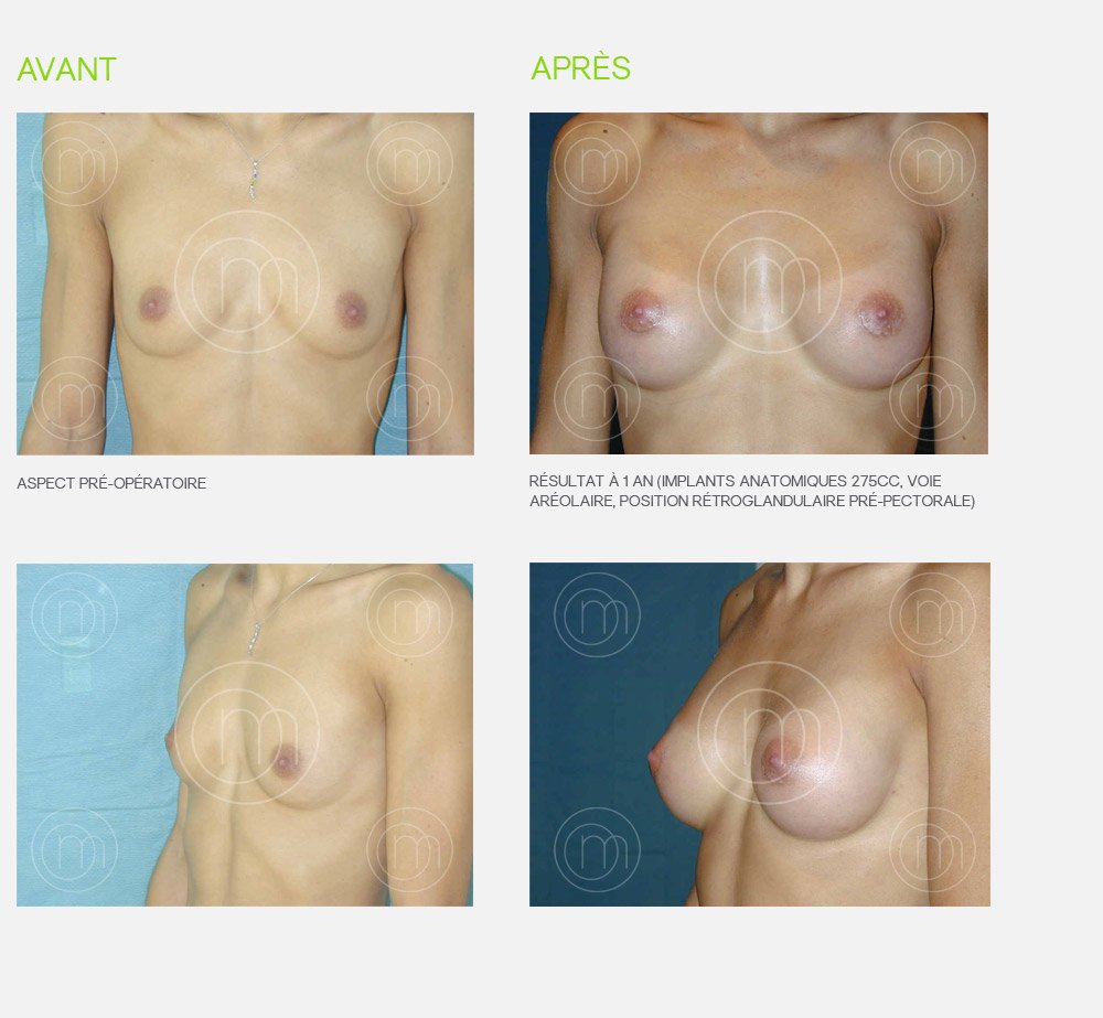 Photo avant / après augmentation mammaire Dr Manise