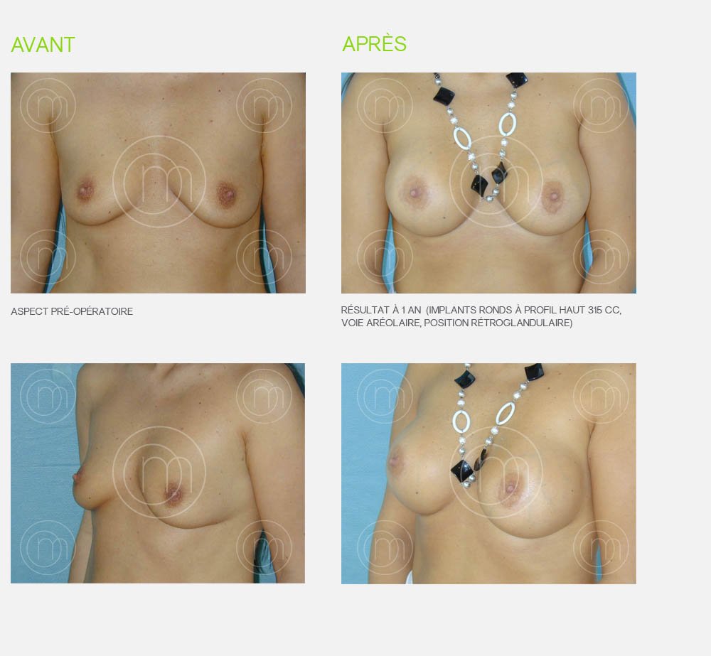 Photo avant / après augmentation mammaire Dr Manise