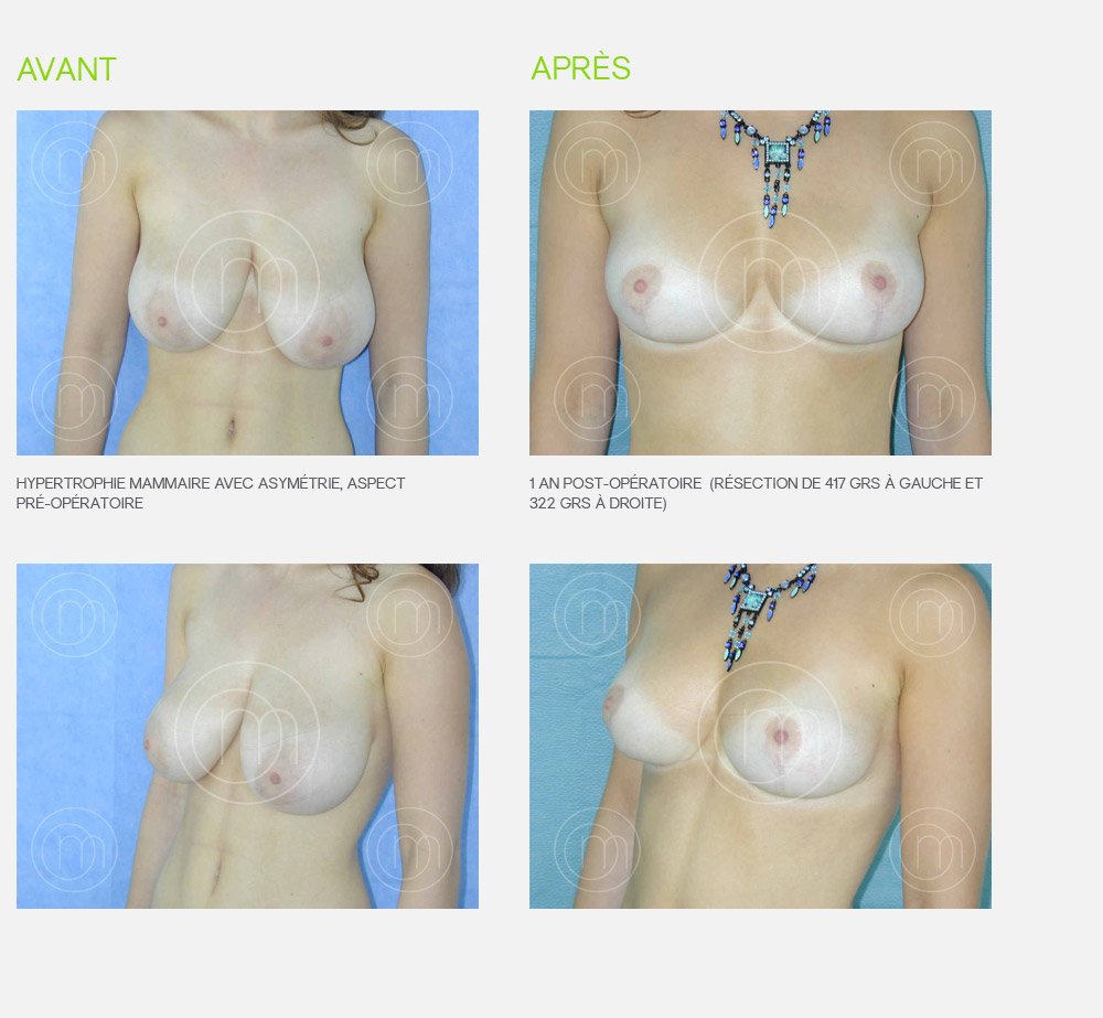 Photo avant / après réduction mammaire Dr Manise