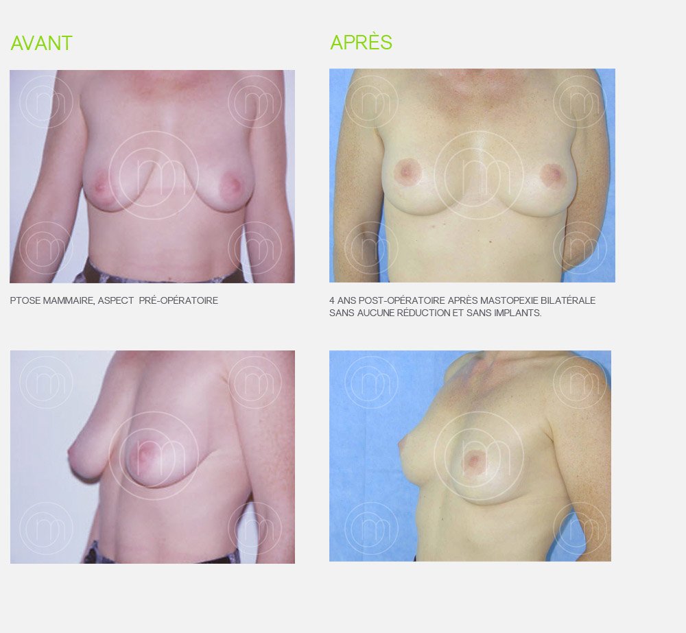 Photo avant / après lifting des seins Dr Manise