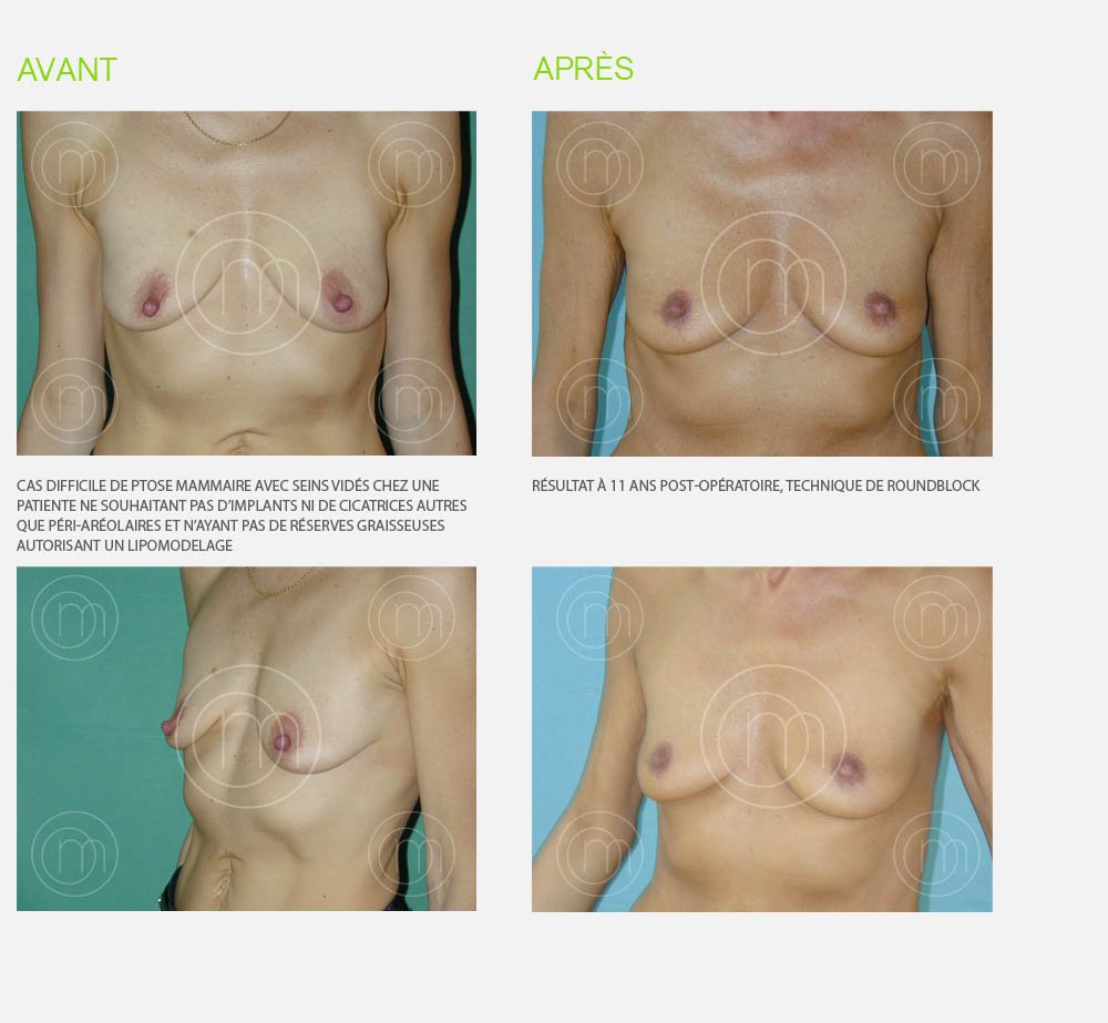 Photo avant / après lifting des seins Dr Manise