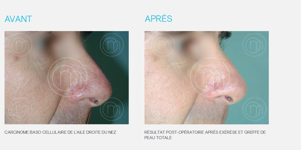 Photo avant / après chirurgie dermatologique Dr Manise