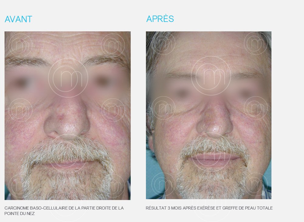 Photo avant / après chirurgie dermatologique Dr Manise