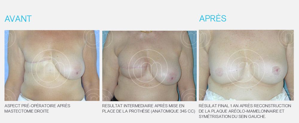 Photo avant / après reconstruction mammaire Dr Manise