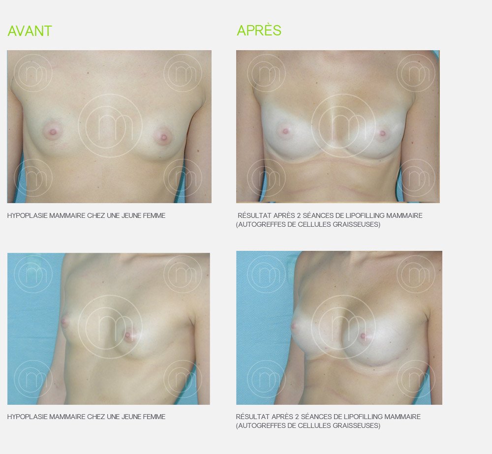 Lipofilling des seins : photo avant / après