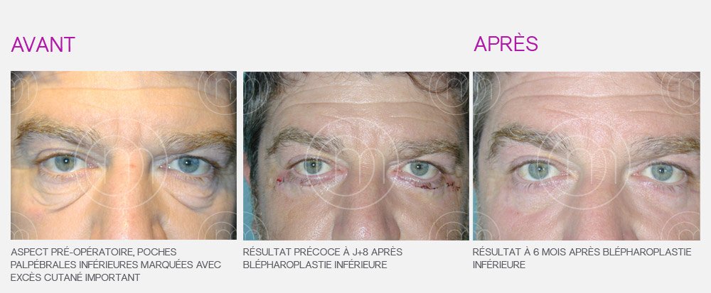 Photo avant / après de blépharoplastie par le Dr Manise chirurgien esthétique