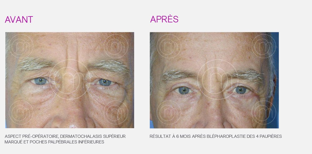 Photo avant / après de blépharoplastie par le Dr Manise chirurgien esthétique