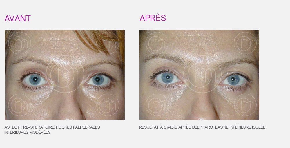 Photo avant / après de blépharoplastie par le Dr Manise chirurgien esthétique