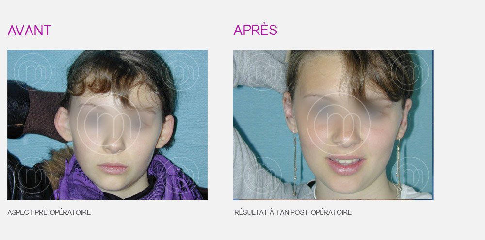 Photo avant / après de chirurgie des oreilles décollées par le Dr Manise