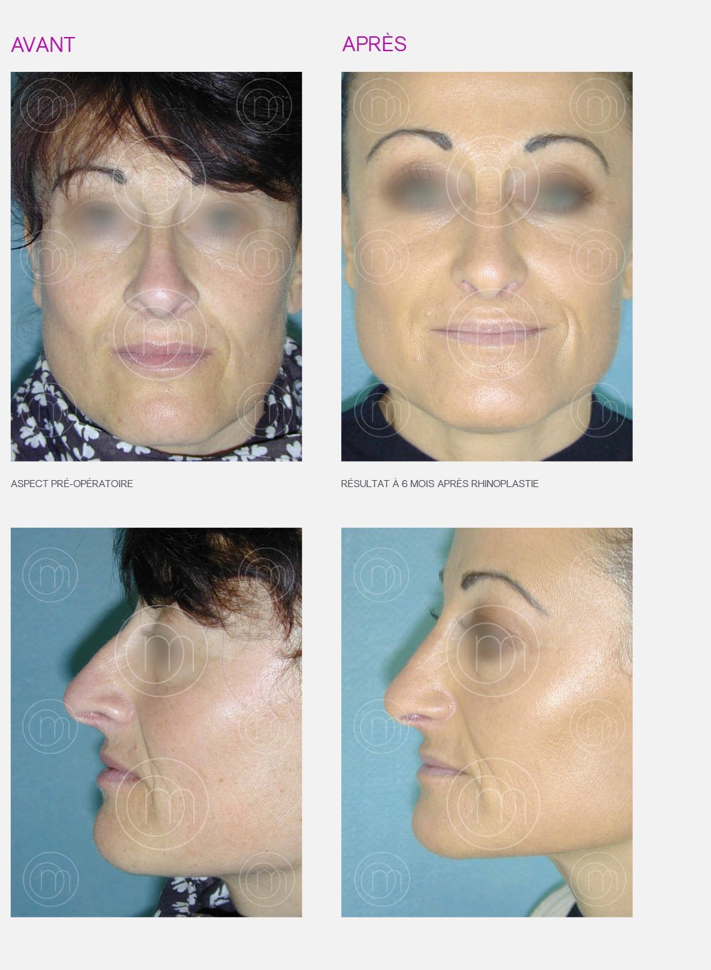 Photo avant / après de rhinoplastie par le Dr Manise chirurgien esthétique