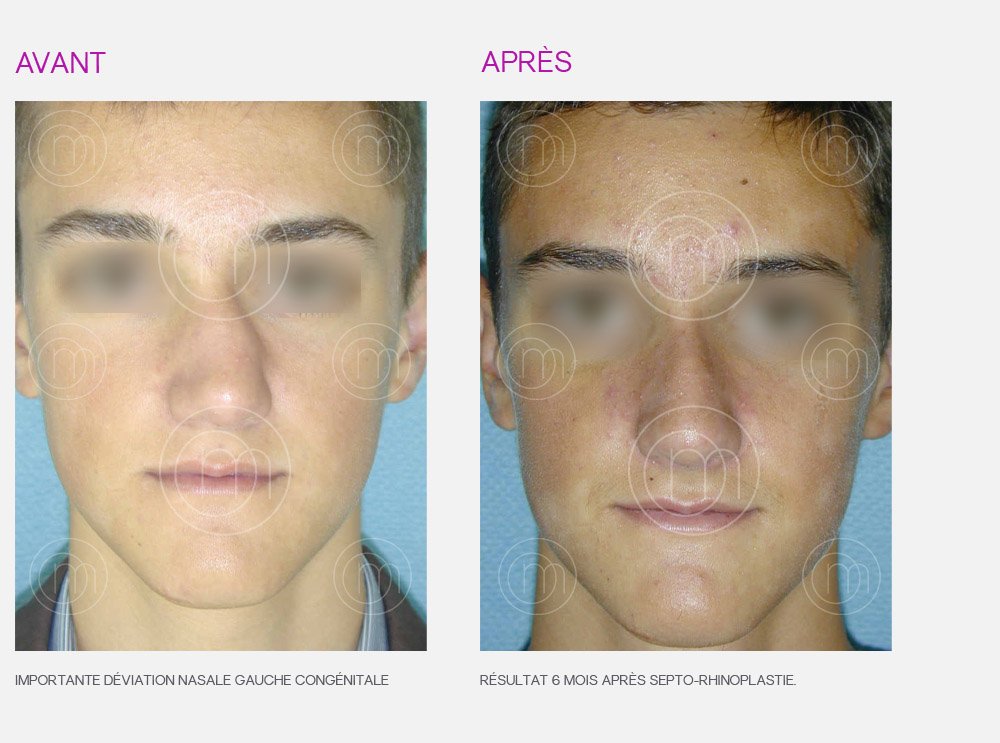 Photo avant / après de rhinoplastie par le Dr Manise chirurgien esthétique